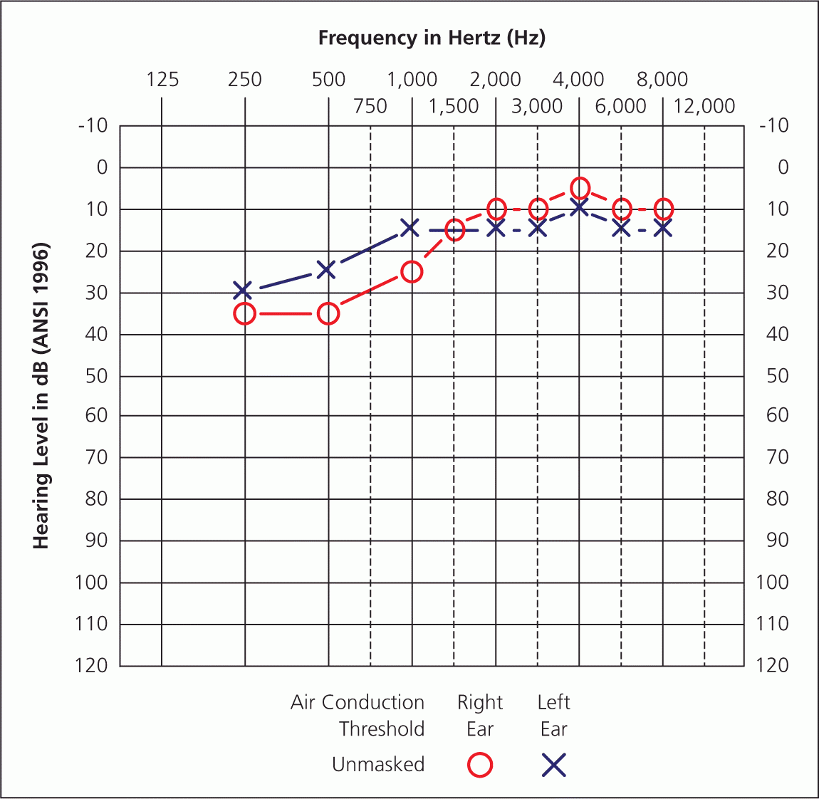 Audiometry Screening And Interpretation AAFP